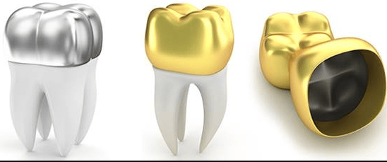Benefits of Esthetic Coated Stainless Steel Crowns