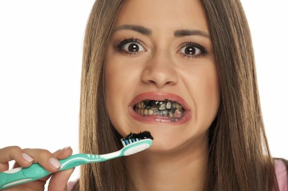 How to Care for Esthetic Coated Stainless Steel Crowns?