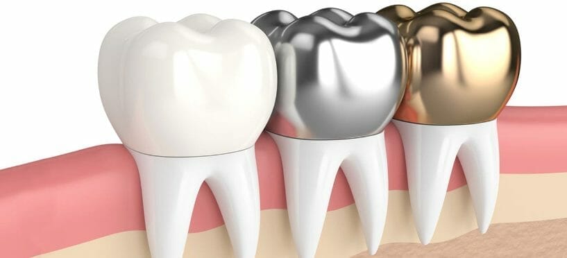 Protect Your Teeth with Esthetic Coated Stainless Steel Crowns