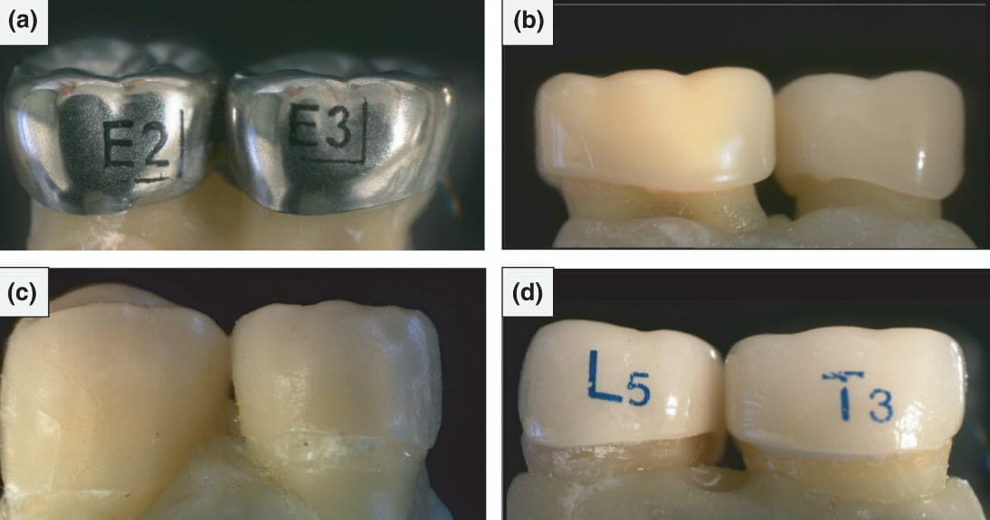 What are Prefabricated Esthetic Coated Stainless Steel Crowns