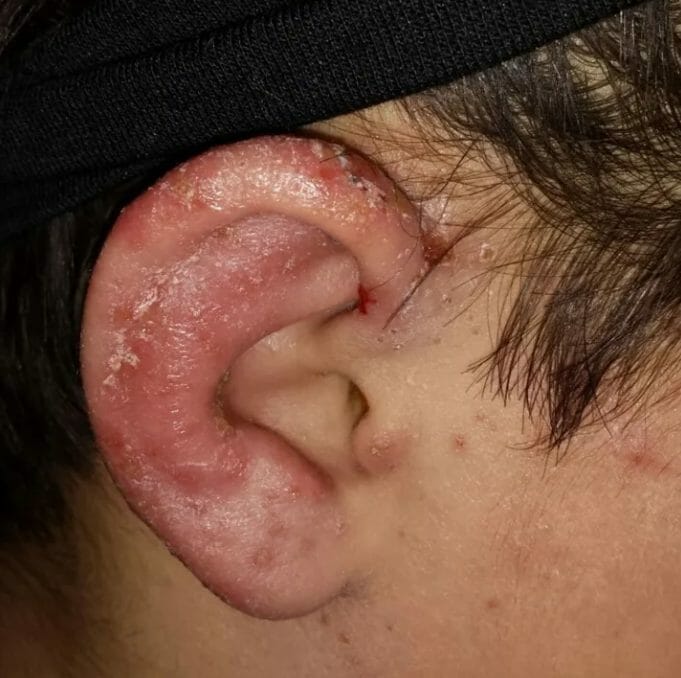 Symptoms of Allergic Reactions to Stainless Steel Earrings